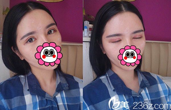 术后25天效果 术后25天效果