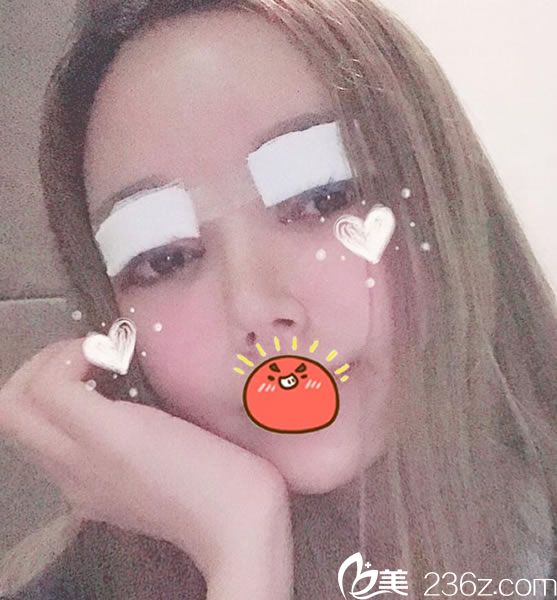 杭州连天美双眼皮修复当天 杭州连天美双眼皮修复当天