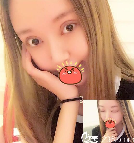 找杭州姜鑫利做双眼皮修复9天后 找杭州姜鑫利做双眼皮修复9天后