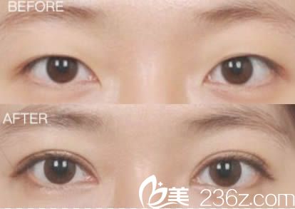 东莞水立方美容医院双眼皮案例图 东莞水立方美容医院双眼皮案例图