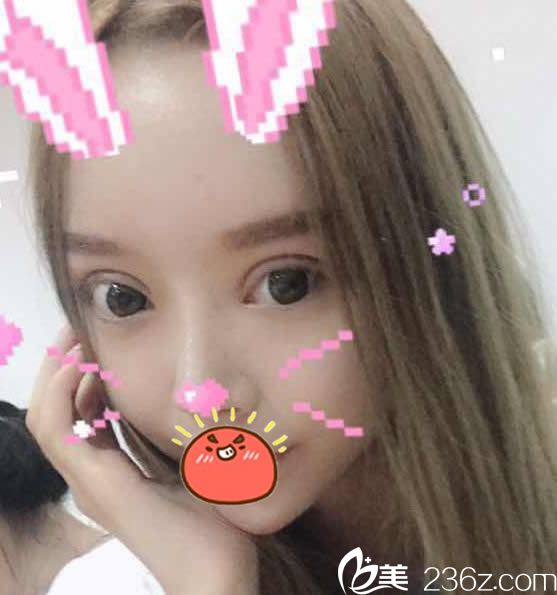 做完双眼皮修复和内外眼角20天效果 做完双眼皮修复和内外眼角20天效果