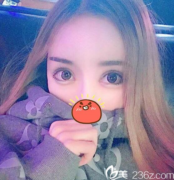 杭州姜鑫利双眼皮修复案例80天效果 杭州姜鑫利双眼皮修复案例80天效果