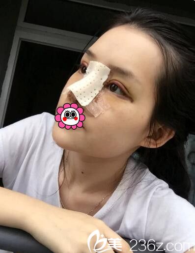 长春海茵做双眼皮手术+假体隆鼻术手术