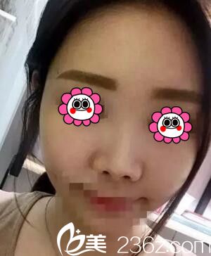 去怀化韩美做鼻综合术前照 去怀化韩美做鼻综合术前照
