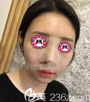 怀化韩美鼻综合术后第2天 怀化韩美鼻综合术后第2天