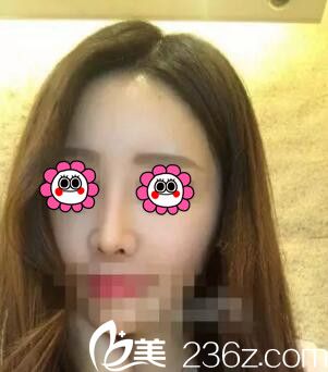 鼻综合术后半个月<span style= 鼻综合术后半个月<span style=