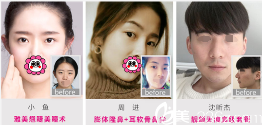 长沙雅美整形医院案例对比图 长沙雅美整形医院案例对比图