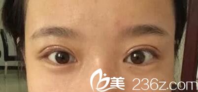在郑州望京整形割双眼皮开眼角术后13天