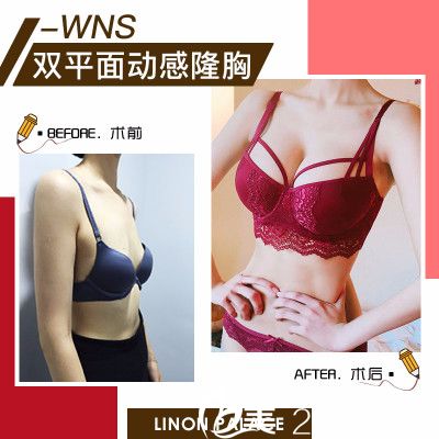 珠海新颜曾超假体隆胸案例对比图