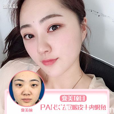 珠海新颜曾超医生双眼皮开眼角案例