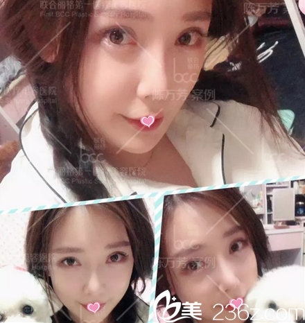 北京联合丽格脂肪填充面部一个月效果