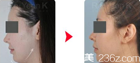 韩国Re Yeon K整形外科医院面部脂肪填充案例 韩国Re Yeon K整形外科医院面部脂肪填充案例