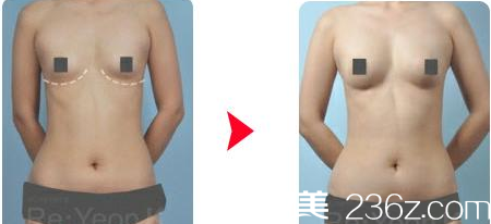 韩国Re Yeon K整形外科医院脂肪丰胸案例