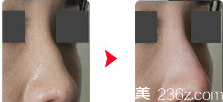 韩国Re Yeon K整形外科医院隆鼻案例 韩国Re Yeon K整形外科医院隆鼻案例