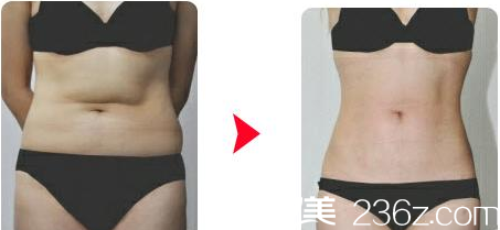 韩国Re Yeon K整形外科医院金贤秀激光腹部吸脂案例 韩国Re Yeon K整形外科医院金贤秀激光腹部吸脂案例