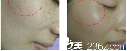 韩国Re Yeon K整形外科医院金贤秀祛斑案例 韩国Re Yeon K整形外科医院金贤秀祛斑案例