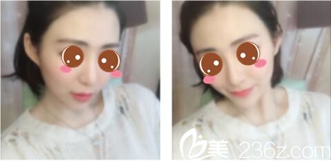 韩国莫德罗皮肤科徐求一埋线提升真人案例术后第七天