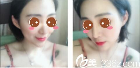 韩国莫德罗皮肤科徐求一埋线提升真人案例术后一个月