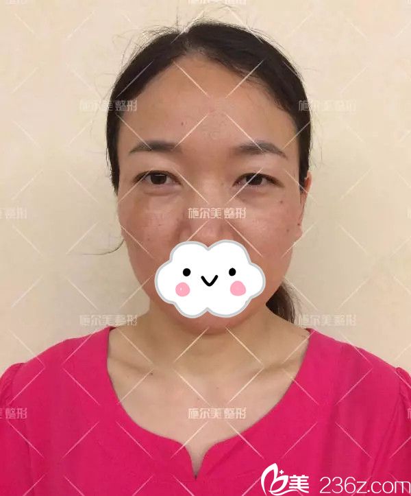 术前咖啡斑眼部问题较多 术前咖啡斑眼部问题较多