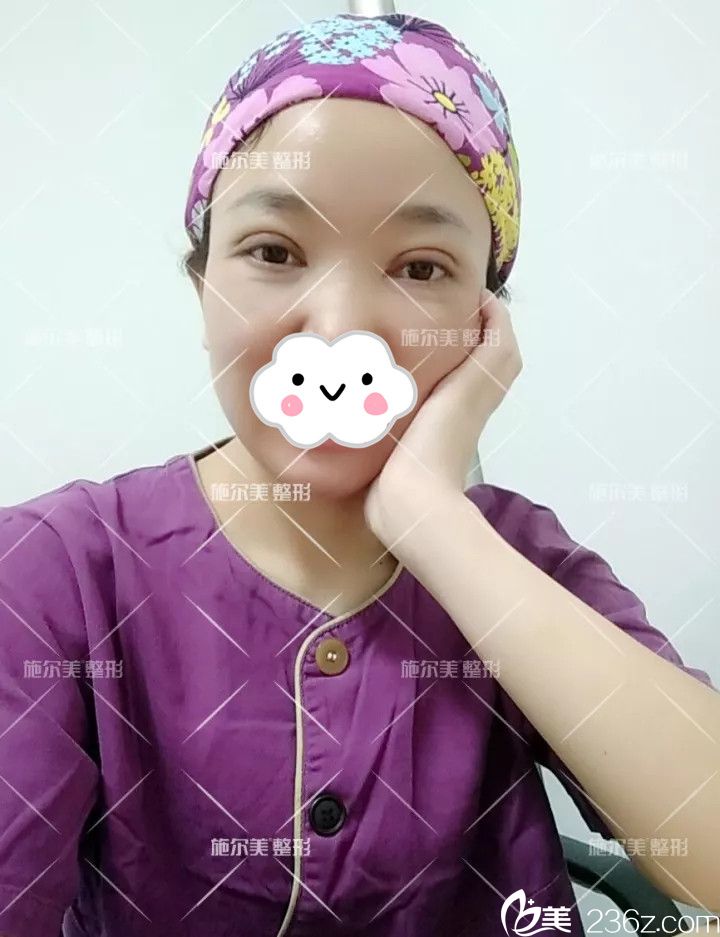 做完眼综合半个月后恢复 做完眼综合半个月后恢复