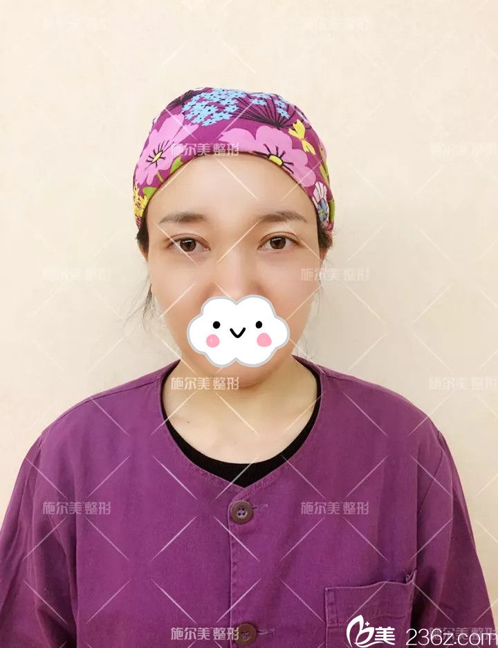 术后22天眼综合和皮秒祛斑恢复 术后22天眼综合和皮秒祛斑恢复