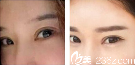 崔贵东院长做半眉案例对比图 崔贵东院长做半眉案例对比图