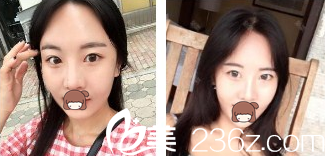 玻尿酸丰下巴加瘦脸整形案例 玻尿酸丰下巴加瘦脸整形案例