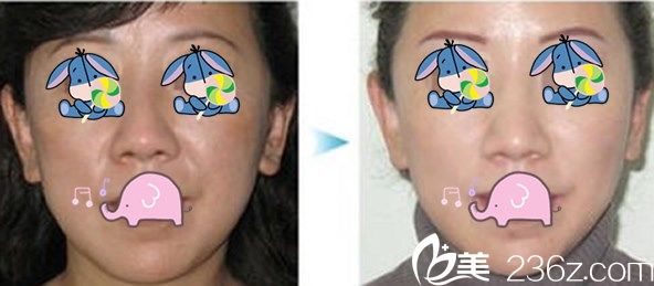 美尔韩整形医院面部提升效果案例 美尔韩整形医院面部提升效果案例