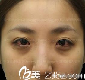 韩国珠儿丽整形医院眼综合及假体隆鼻术前照 韩国珠儿丽整形医院眼综合及假体隆鼻术前照