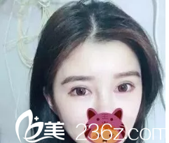 术后第30天，我的双眼皮完全恢复好了