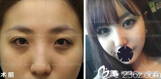 韩国珠儿丽整形眼综合及隆鼻效果对比照 韩国珠儿丽整形眼综合及隆鼻效果对比照