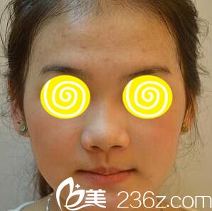 在韩国蓝天感觉做注射隆鼻前 在韩国蓝天感觉做注射隆鼻前