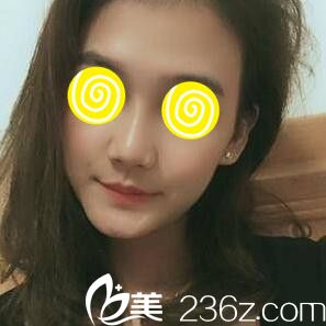 玻尿酸隆鼻术后第三天效果 玻尿酸隆鼻术后第三天效果