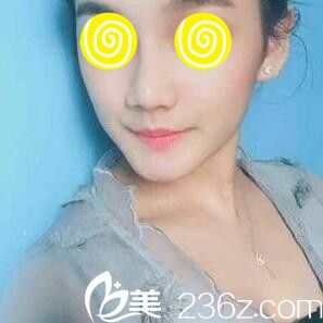 在韩国蓝天感觉昨玻尿酸隆鼻第五天效果 在韩国蓝天感觉昨玻尿酸隆鼻第五天效果