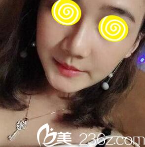 在韩国注射玻尿酸隆鼻半个月效果 在韩国注射玻尿酸隆鼻半个月效果