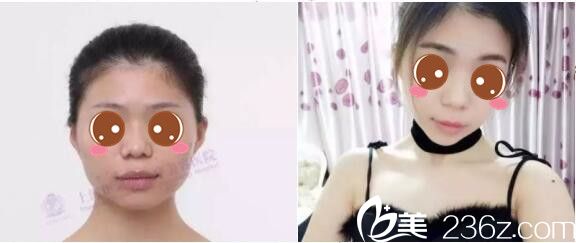 上海伊莱美医疗美容医院李湘原下颌角整形真人案例