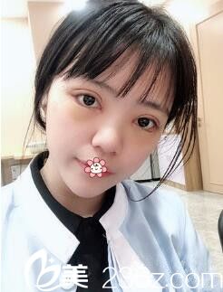 黄皓双眼皮加开内眼角术后五天 黄皓双眼皮加开内眼角术后五天