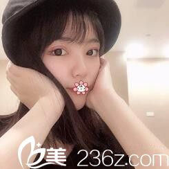 贵阳华美双眼皮加开内眼角术后一个月 贵阳华美双眼皮加开内眼角术后一个月