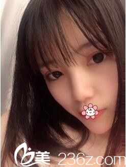 贵阳华美黄皓开内眼角加双眼皮术后两个月效果 贵阳华美黄皓开内眼角加双眼皮术后两个月效果