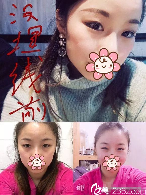 术前内双想做埋线双眼皮 术前内双想做埋线双眼皮