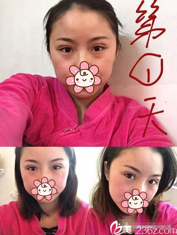 刚做完埋线双眼皮天肿胀 刚做完埋线双眼皮天肿胀