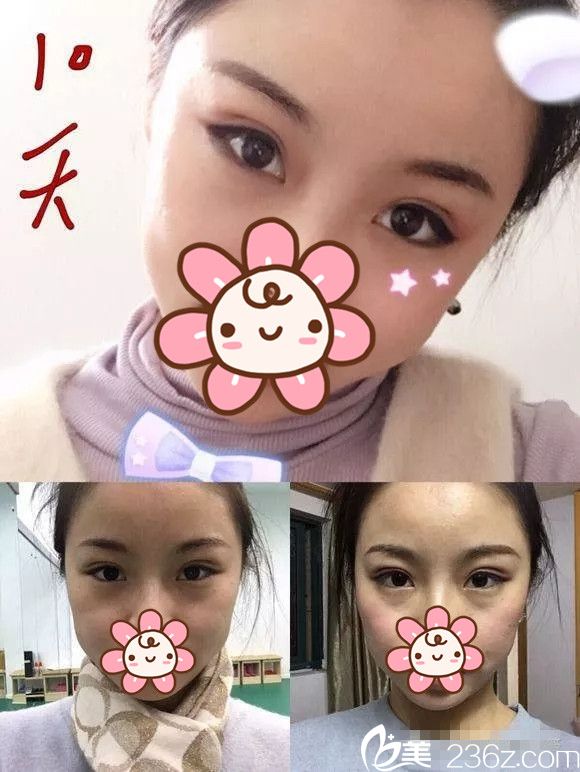 做完埋线双眼皮十天肿胀不太明显 做完埋线双眼皮十天肿胀不太明显