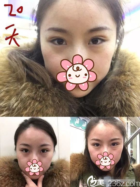 埋线双眼皮术后20天恢复 埋线双眼皮术后20天恢复