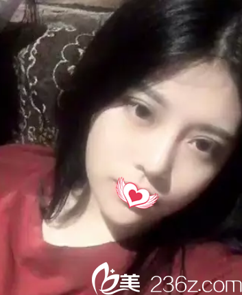 硅胶隆鼻10天后鼻子消肿