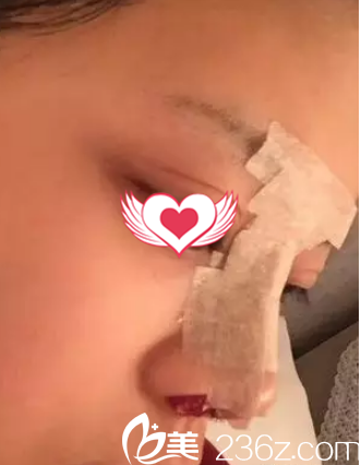 刚做完硅胶隆鼻后鼻子肿胀
