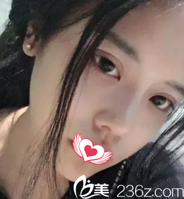 硅胶隆鼻25天鼻子高挺