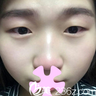 我在太原欧美莲整形美容医院做双眼皮之前的照片 我在太原欧美莲整形美容医院做双眼皮之前的照片