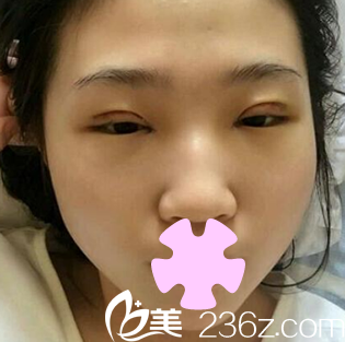 太原欧美莲姚冰给我做全切双眼皮术后第3天照片 太原欧美莲姚冰给我做全切双眼皮术后第3天照片