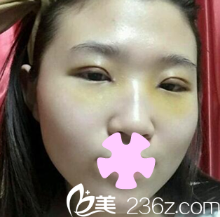 太原欧美莲姚冰给我做双眼皮和开眼角术后第7天照片 太原欧美莲姚冰给我做双眼皮和开眼角术后第7天照片