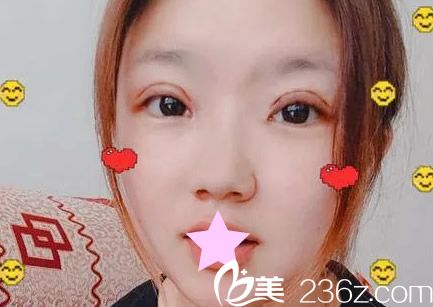 割双眼皮第四天